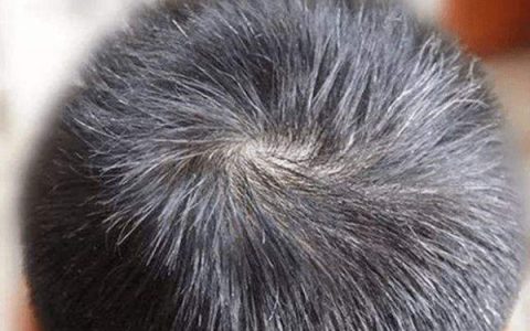 遗传白头发能染头发吗(白头发不是遗传可以染发吗)