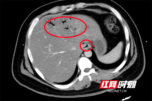 21岁衡阳男子久坐不动常喝饮料 血糖超标20多倍住进EICU