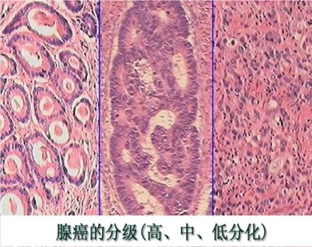 肿瘤分化的定义，肿瘤细胞的分型