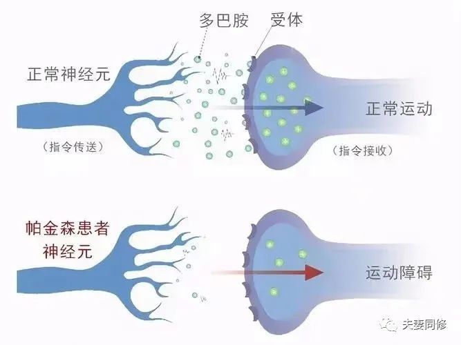 适当的性生活可以改善帕金森？这是真是假？？？